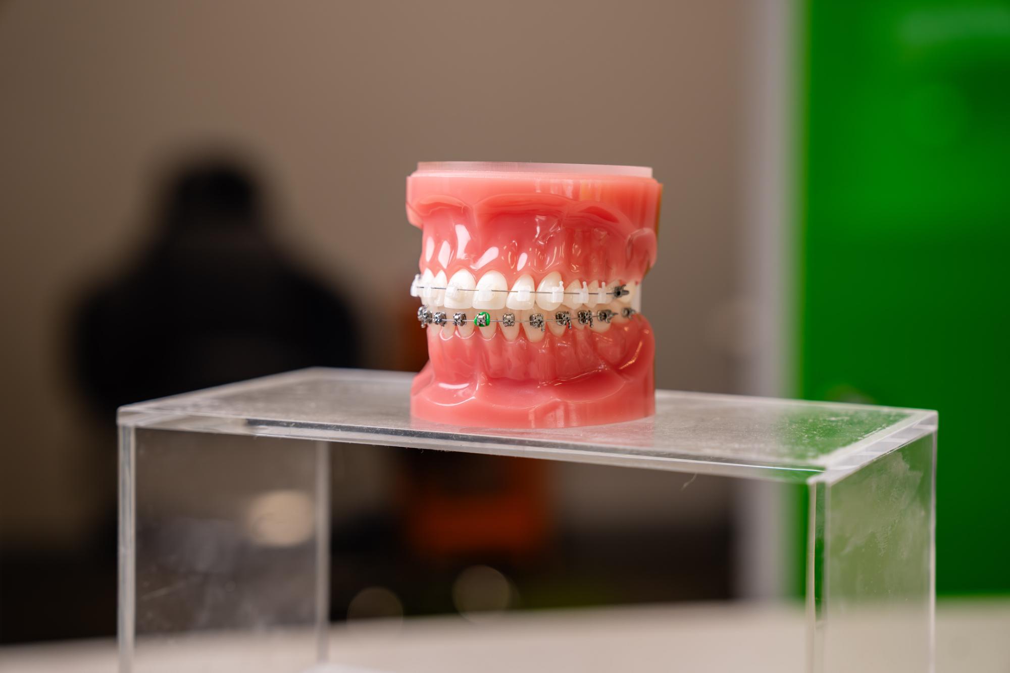 Clear Braces